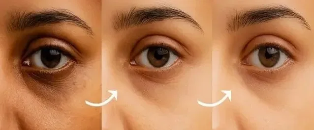 Eye Revive محاربة الهالات و الانتفاخ تحت العينين