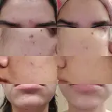 Anua Azelaic Acid 10+ Hyaluron Serum