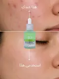 Anua Azelaic Acid 10+ Hyaluron Serum