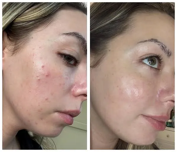 Anua Azelaic Acid 10+ Hyaluron Serum