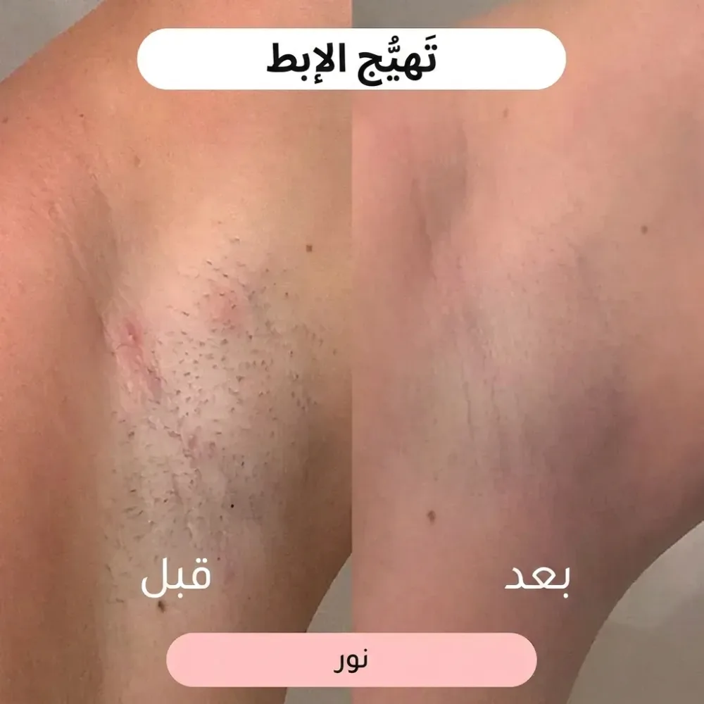 ماكينة حلاقة نسائية 2 في 1 🌸(عرض خاص لفترة محدودة فقط!)