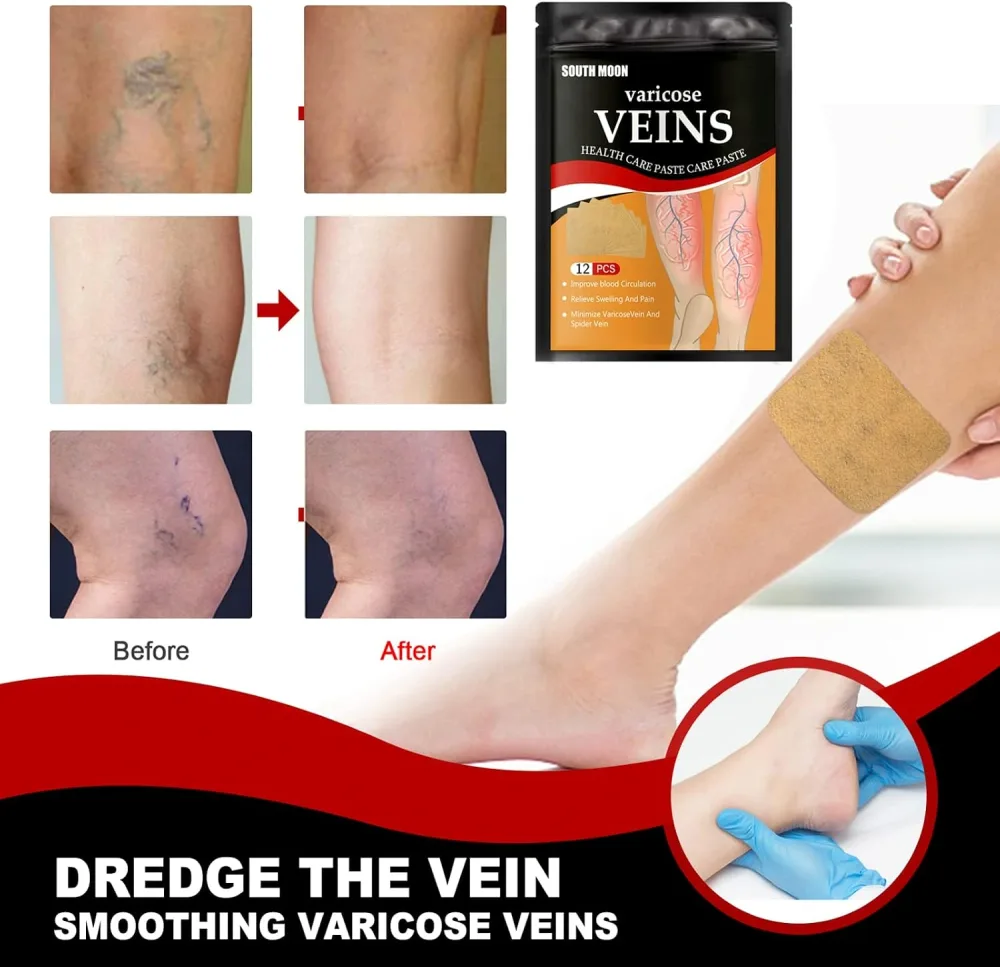 Patchs Herbales Anti-Varices Soulagement Douleur, Amélioration Circulation 12Pcs - لاصقات الأعشاب الطبيعية لعلاج الدوالي والدورة الدموية