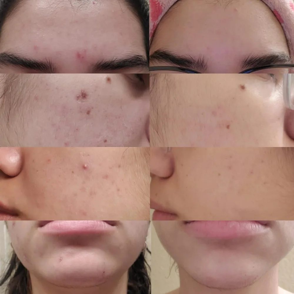 Anua Azelaic Acid 10+ Hyaluron Serum