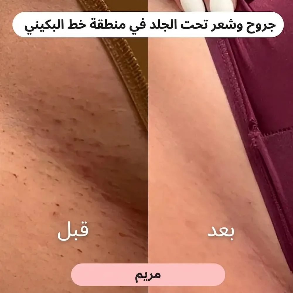 ماكينة حلاقة نسائية 2 في 1 🌸(عرض خاص لفترة محدودة فقط!)