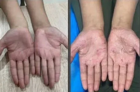 كريم القضاء على الصدفية و الأكزيما